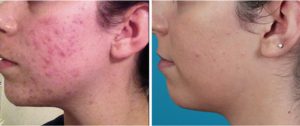 recurring facial pimples treatment beverly hills