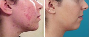 before-after-acne-photo