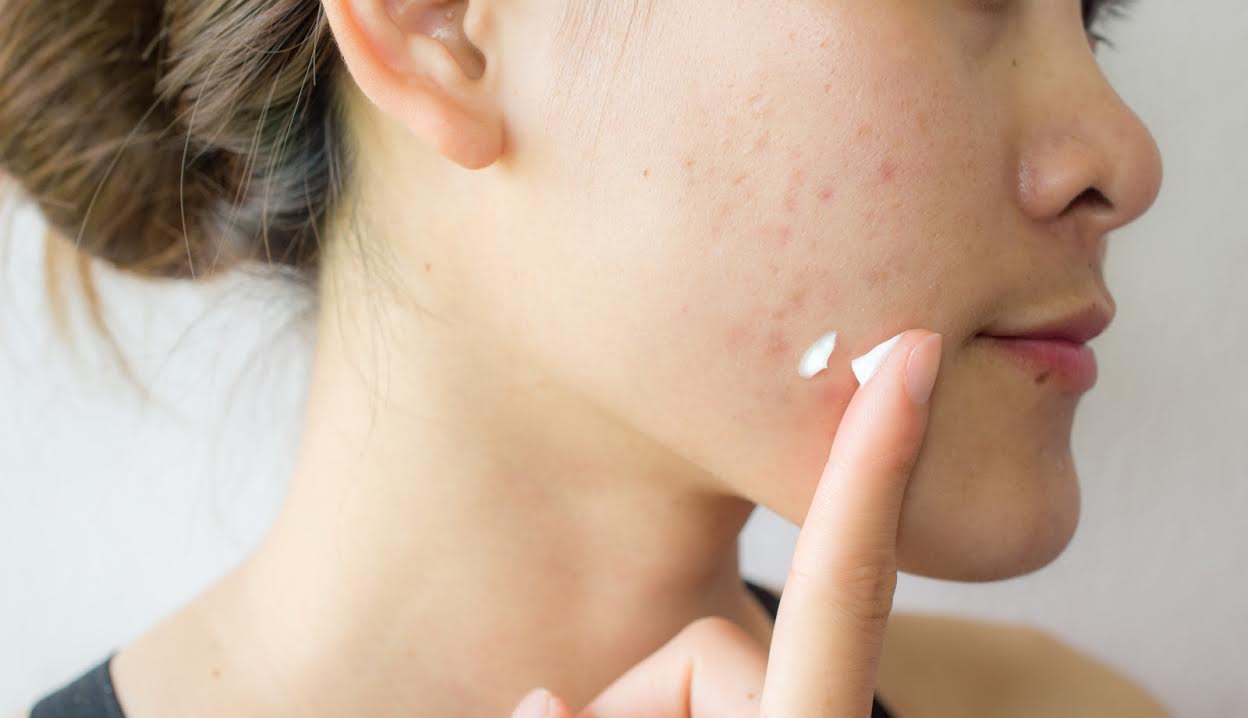 Dr. Ava’s Tips for Treating a Pimple 2