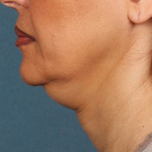 ava md results