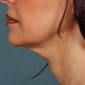 ava md results