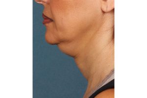 double chin before 3 3