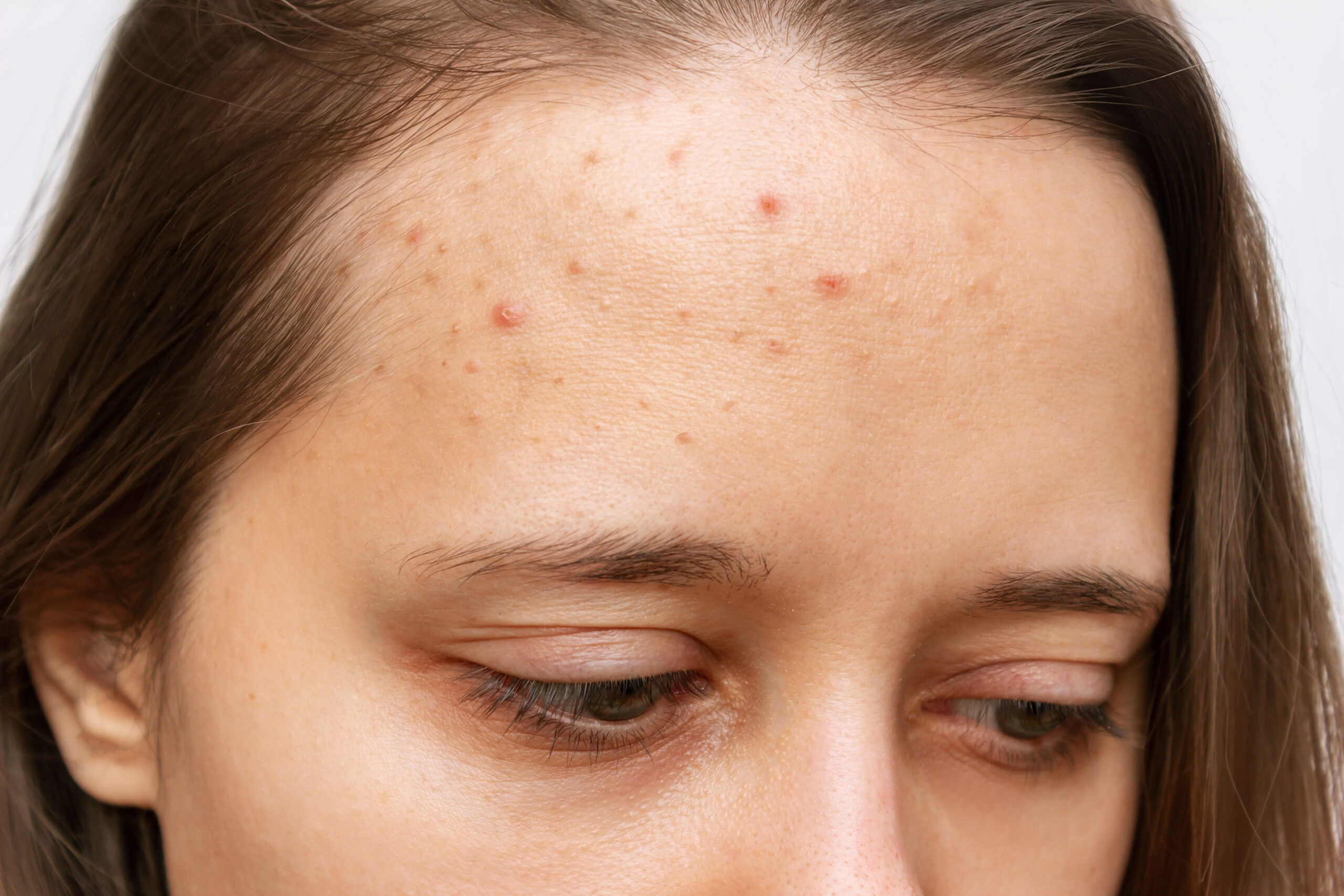 Acne Treatment Clinic 4