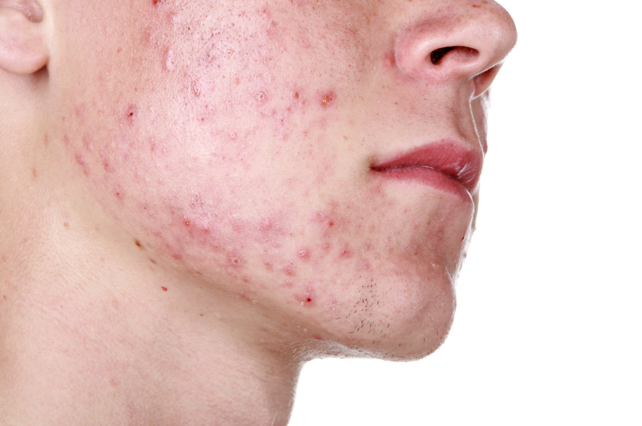 Acne Treatment Clinic 3